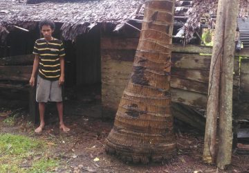 Hanya Karena Cacat Fisik, Anak ini Ditelantarkan Orang Tuanya