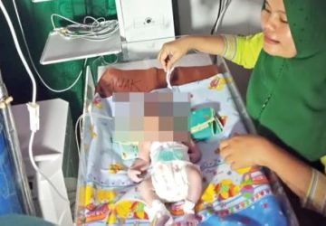 Bayi Bermata Satu Lahir di Mandailing Natal Sumut, Begini Penjelasan Sains!