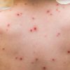 57 Kasus Rubella Ditemukan di Jambi