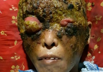 Sarpia Wanita Asal Mejene Ini Butuh Uluran Tangan Para Dermawan