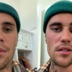 Mengenal Ramsay Hunt Syndrome, Sindrom Langka yang Diidap Justin Bieber