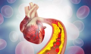 10 Obat Kolesterol yang Efisien dan Bisa Didapat di Apotik