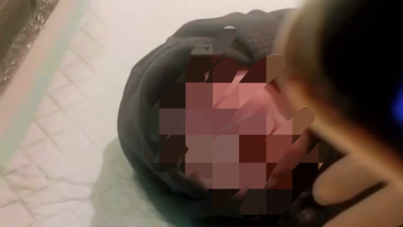 Bayi Lahir Tanpa Hidung di Wawonii Hebohkan Warga