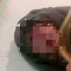 Heboh Bayi Lahir Tanpa Hidung, Ini Penjelasan Medisnya